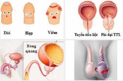 Bao quy đầu bị dính gây viêm nhiễm nam khoa